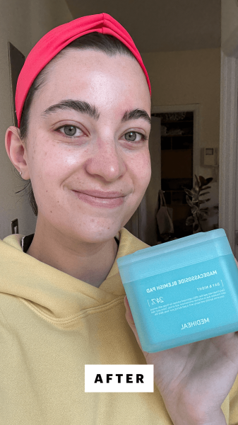 Felbin after applying the Mediheal Madecassoside Blemish Pads